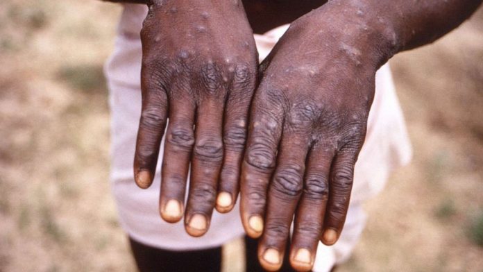 Monkeypox: Nigeria records 157 cases, four deaths